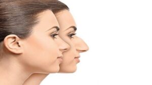 جراحی بینی استخوانی در مشهد