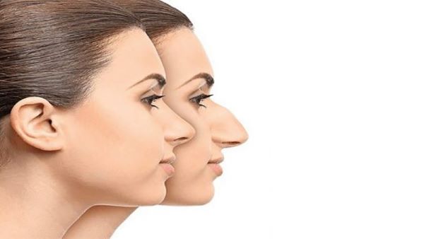 جراحی بینی استخوانی در مشهد