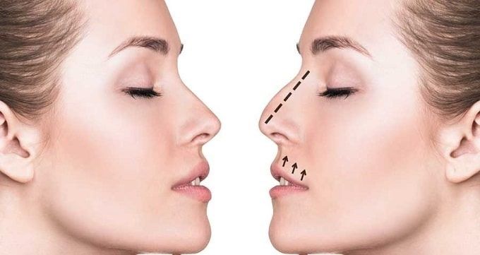 عکس انجام عمل تیپ پلاستی